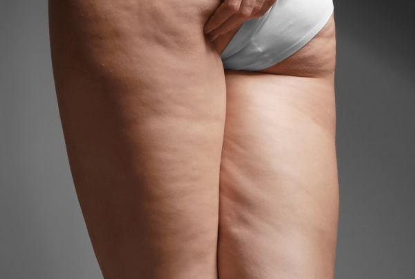 Tips For Beating Cellulite