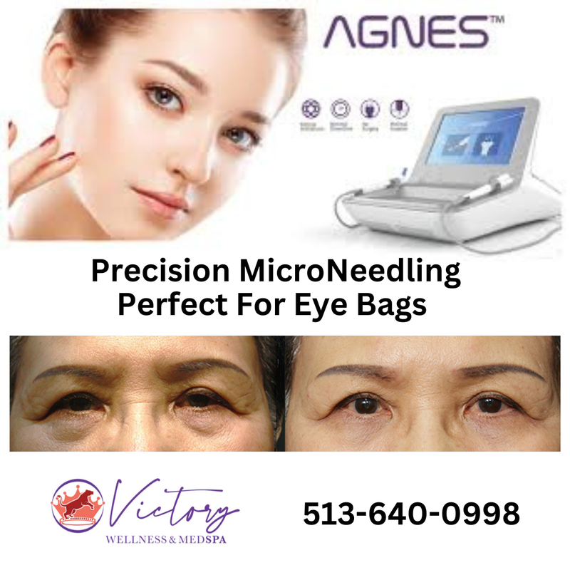 Agnes RF Precision Microneedling