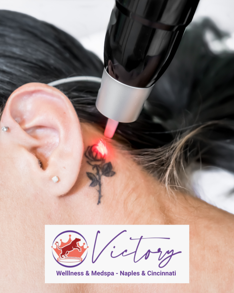 Laser Tattoo Removal Near Me Cincinnati